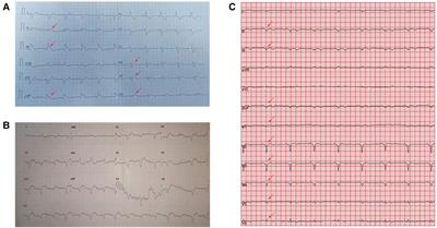 Successful rescue of fulminant myocarditis with mechanical circulatory support and immunosuppression therapy: A case report